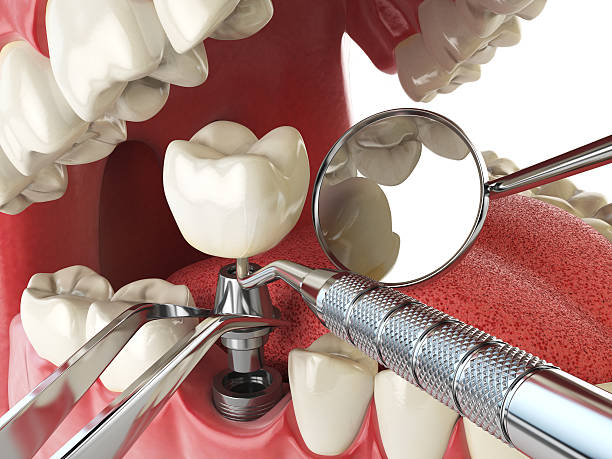 Best Broken or Chipped Tooth Repair in White House Station, NJ